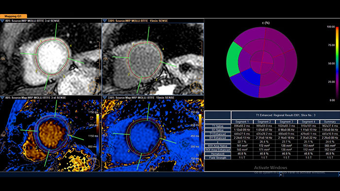 cardiac quantitative mapping thumbnail
