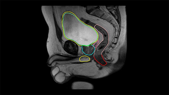 MRCAT Prostate