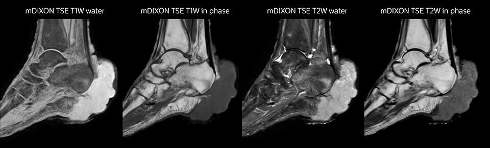 mDIXON TSE of ankle