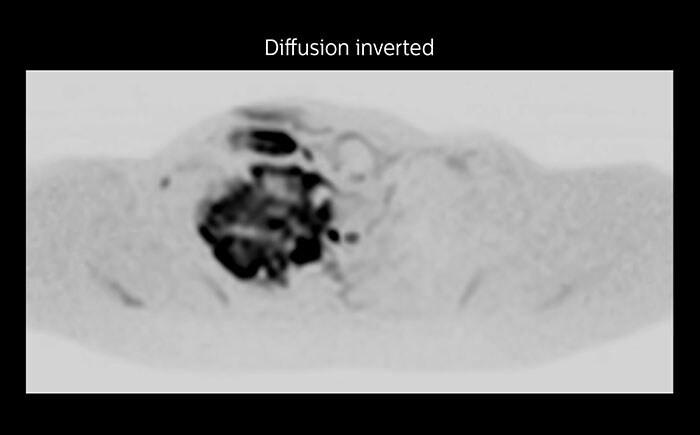 Prodiva MRI pancoast tumor DWI, Seirei Mikatahara