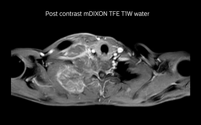Prodiva MRI pancoast tumor mDixon, Seirei Mikatahara