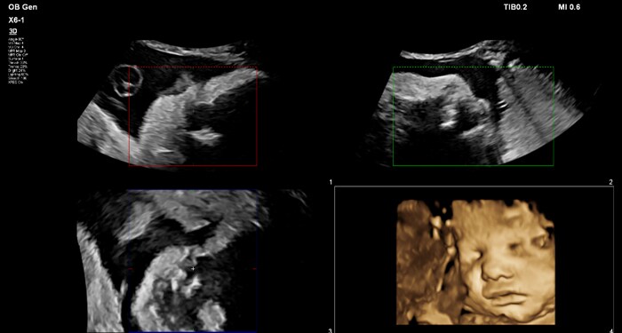 X6-1 OB 3D MPR MaxVue