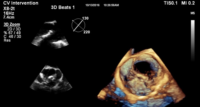 X8-2t 3D Zoom Bicuspid MaxVue