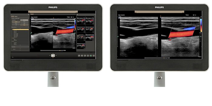 Viewing area comparison with a vascular ultrasound image on screen