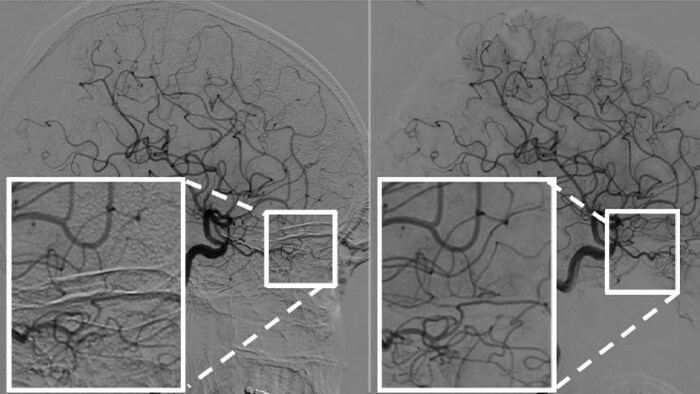 Lesion boundaries CT Roadmap