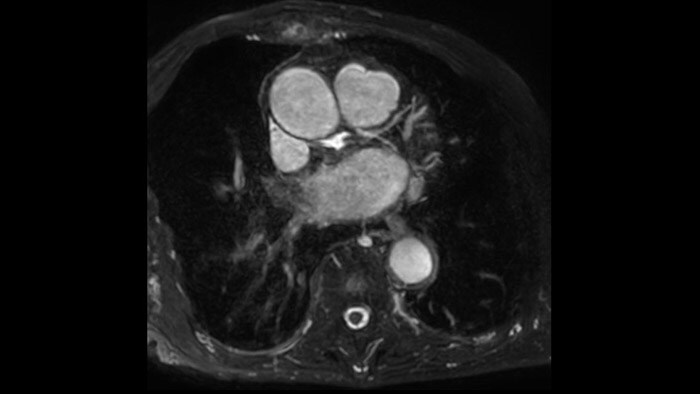 Coronaries LCX