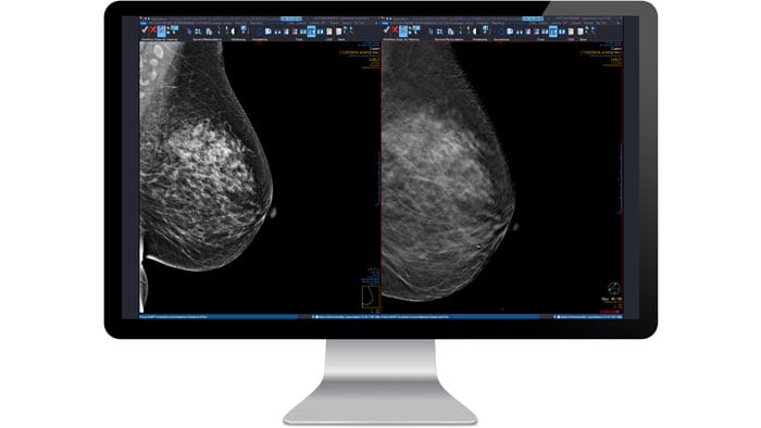 mammography scan on computer screen