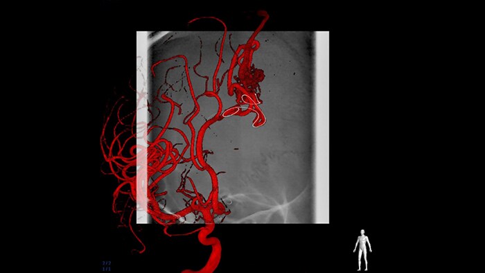 SmartCT Roadmap aids fast navigation through complex vessel structures