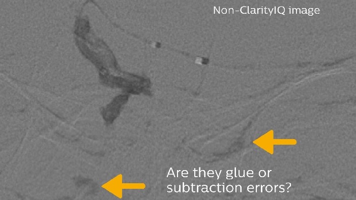 Differentiate between glue and subtraction error