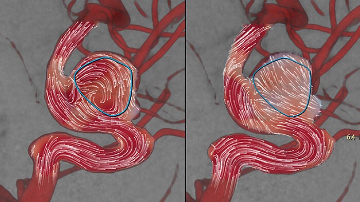 AneurysmFlow image