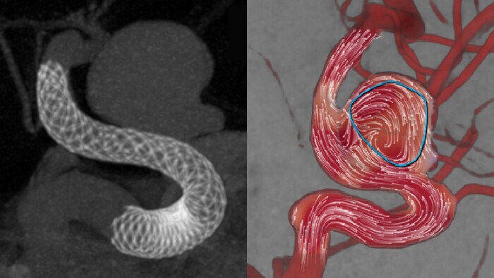 Aneurysmflow image