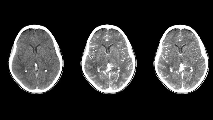 Ishemic stroke treatment