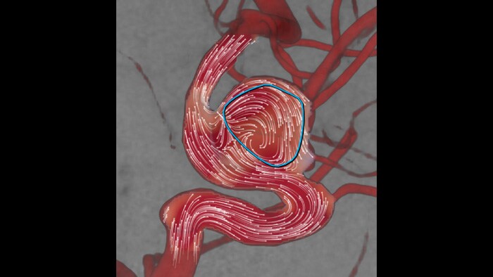 Aneurysmflow image