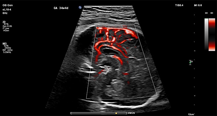 Fetal bowel with MicroFlow Imaging compare
