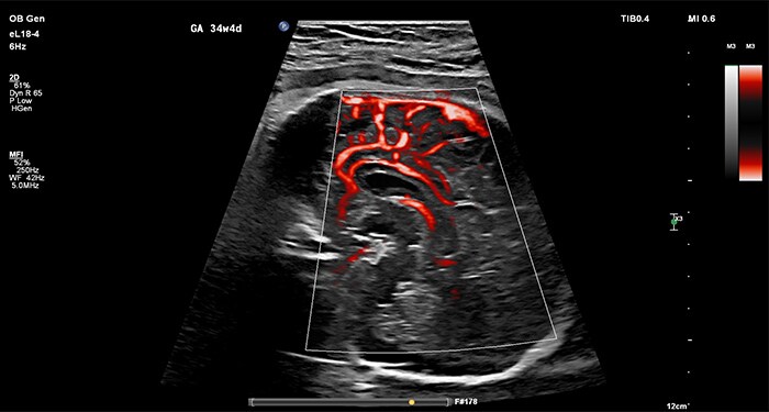 Fetal bowel with MicroFlow Imaging compare