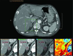 Adrenal