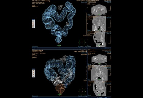 virtual colonoscopy