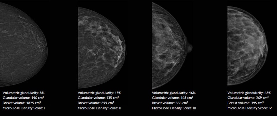 microdose si spectral imaging breast density measurements LM