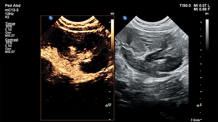 Contrast VCUG of left kidney