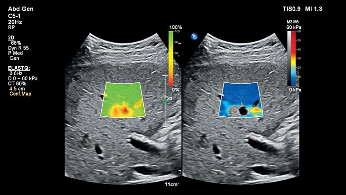 ElastQ Imaging shear