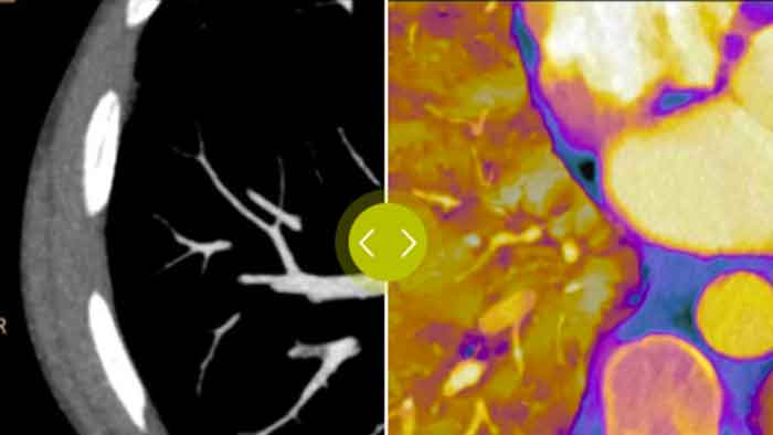 IQon Spectral CT